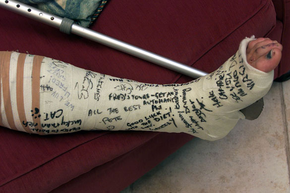 Flintoff retires: Flintoff stress fracture 2000