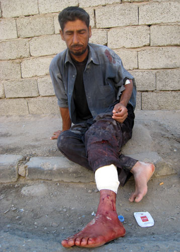 Bombings In Iraq. Iraq bombings: A wounded man