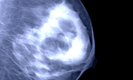mammogram images of breast cancer. A mammogram of a reast