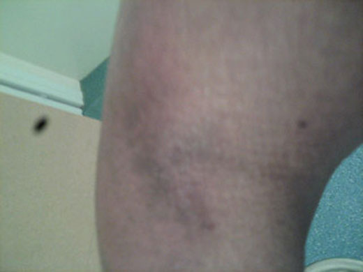 Yarl's Wood Injuries: Yarl's Wood Injuries