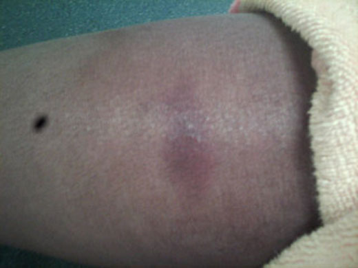 Yarl's Wood Injuries: Yarl's Wood Injuries