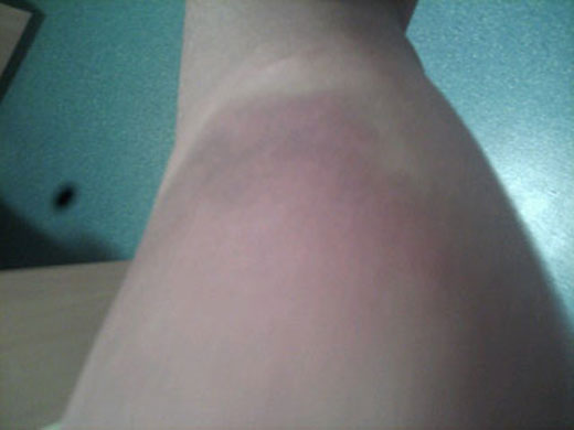 Yarl's Wood Injuries: Yarl's Wood Injuries