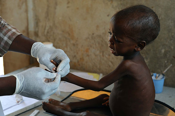 Niger Children: Appoua, 36 months, being examined by nurse Ali at the stablisation clinic