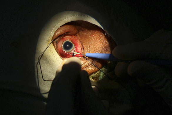 24 hours in pictures: Yogyakarta, Indonesia: A doctor carries out a cataract operation
