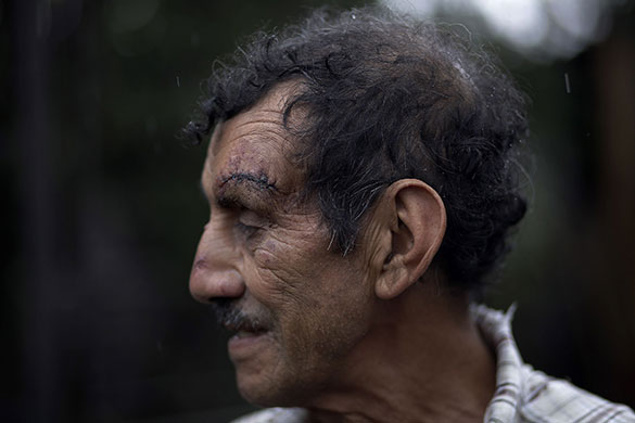 Guatemala volcano: A man shows injuries the Pacaya Volcano in Guatemala