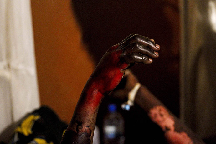 Congo tanker explosion: A burned man who survived an oil explosion raises his hand at a hospital