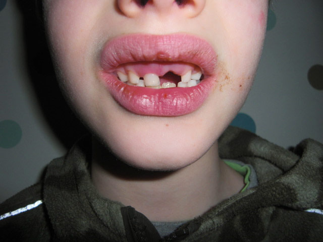 In pictures: Loss: Missing tooth