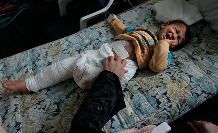 Misrata: In pictures: Wounded Libyan girl, 3 suffers with her injuries sustained by shrapnel