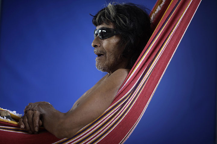 24 hours in pictures: A man from Kayapo tribe wears a pair of sunglass after surgery 