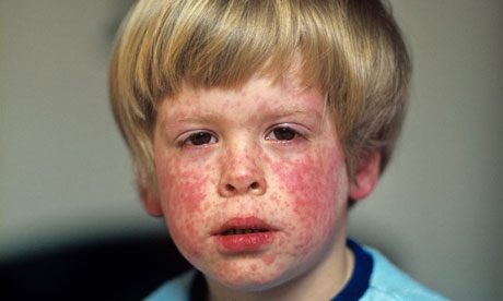 Measles Cases