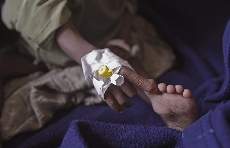 24 hours in pictures: A child suffering from malnutrition in Dadaab, Kenya