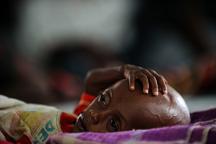 24 hours in pictures: Child suffering from severe malnutrition lies on a cot, Kenya