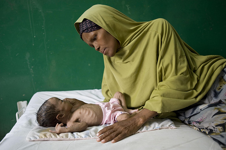 Puntland Somalia : Abdiqaadir Jibril, 2 months old, in Bosaso stabilisation centre 