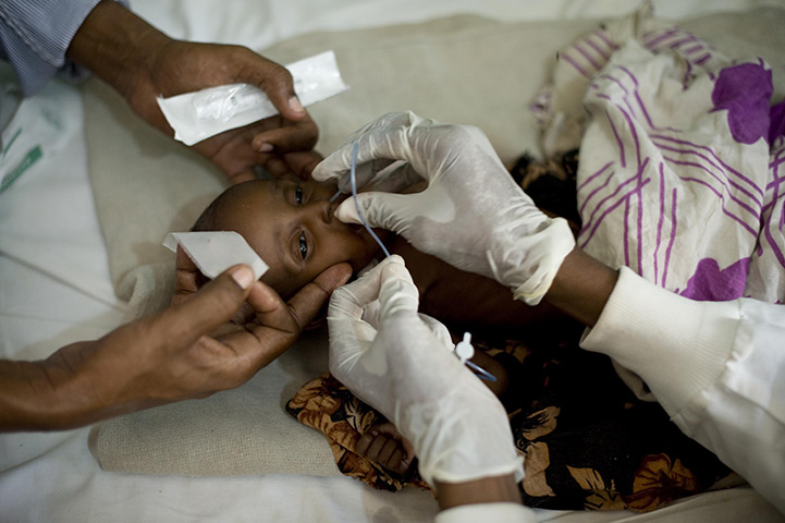 Puntland Somalia : A feeding tube is inserted through Aisha's nose