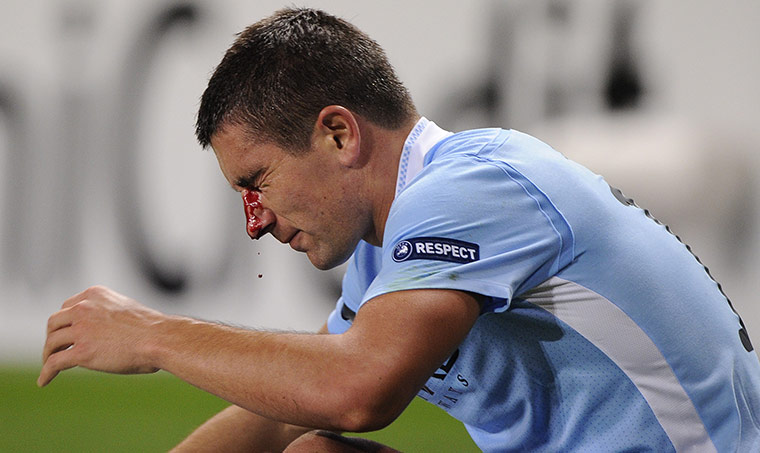 Manchester City v Napoli: Aleksandar Kolarov breaks his nose in the 1st half against Napoli
