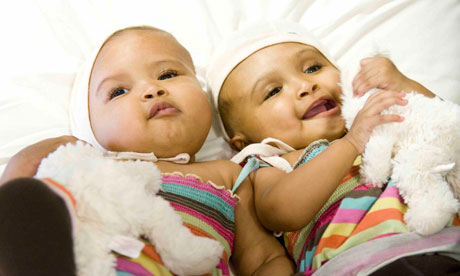 Bayi Kembar Craniopagus