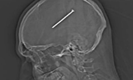 The nail in Daniel Autullo's head, shown on an X-ray