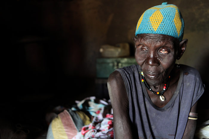 Malaria Consortium: 59 year old Nyanjanmut Gok suffers from blindness associated with trachoma