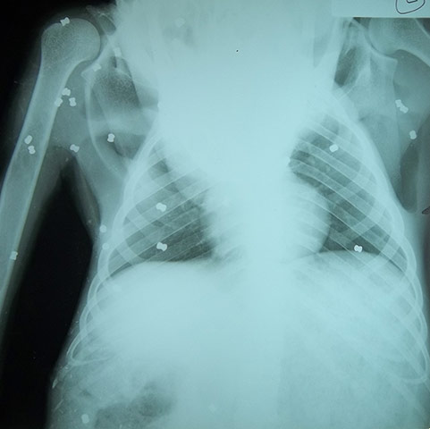 Bornean Orangutan: Aan With 104 Air Gun Pellet Wounds