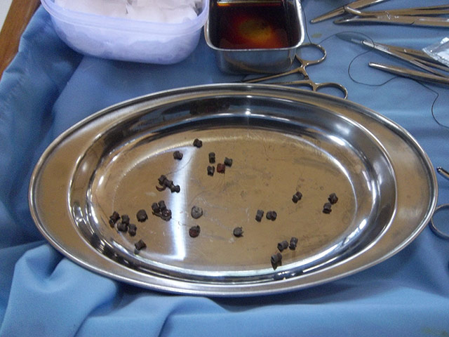 Bornean Orangutan: Aan With 104 Air Gun Pellet Wounds