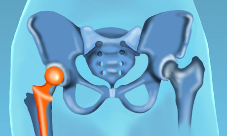 Hip prosthesis
