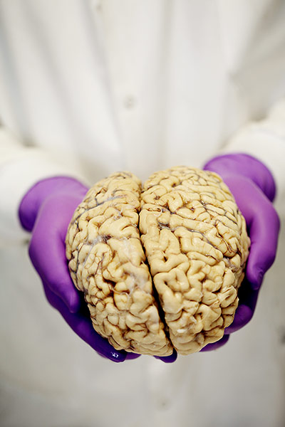 brain: A brain ready for dissection at the Brain Bank