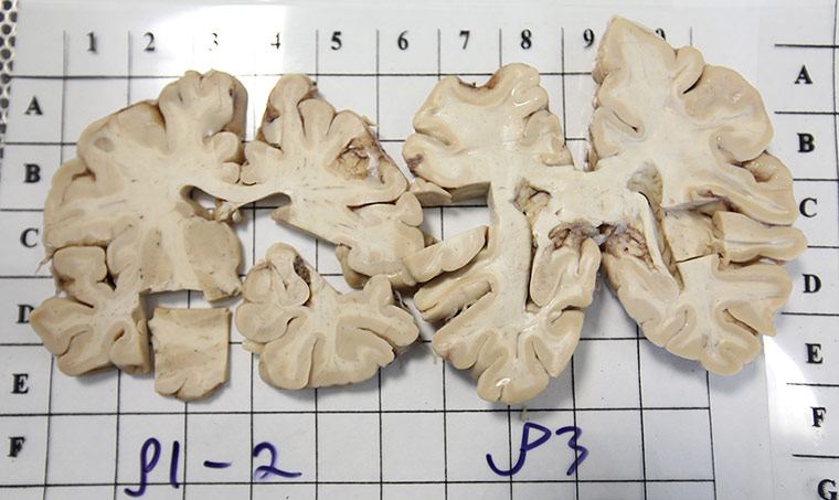 brain: A brain segment dissected and labelled.