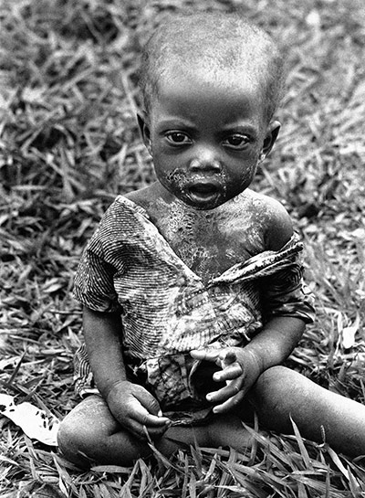 Horst Faas gallery: A sick and hungry Baluba child
