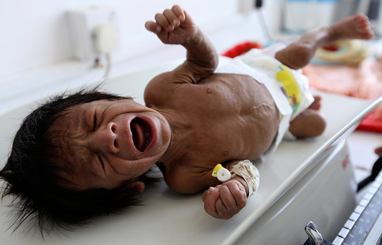 Picture Desk Live: Malnourished child lies on a weighing scale at a hospital in Sanaa
