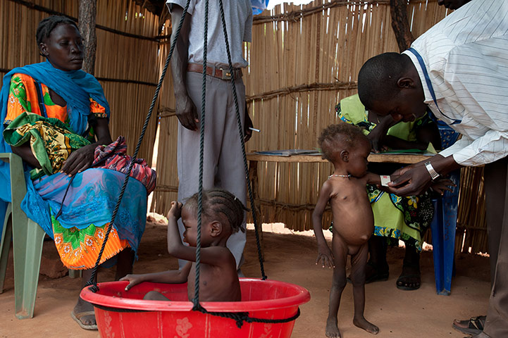 Picture desk live: malnourished children are being measured by Aid workers in south Sudan