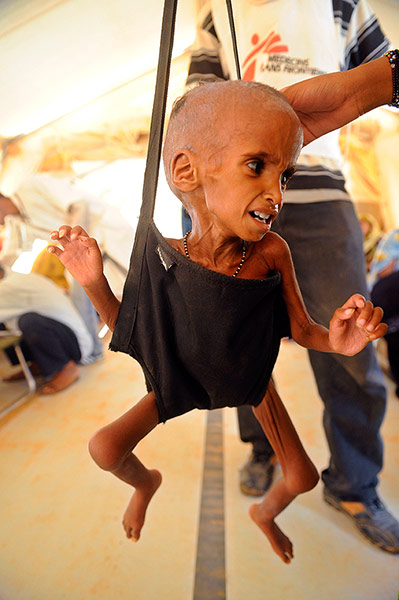 Longer View: A malnurished Malian refugee child is weighed