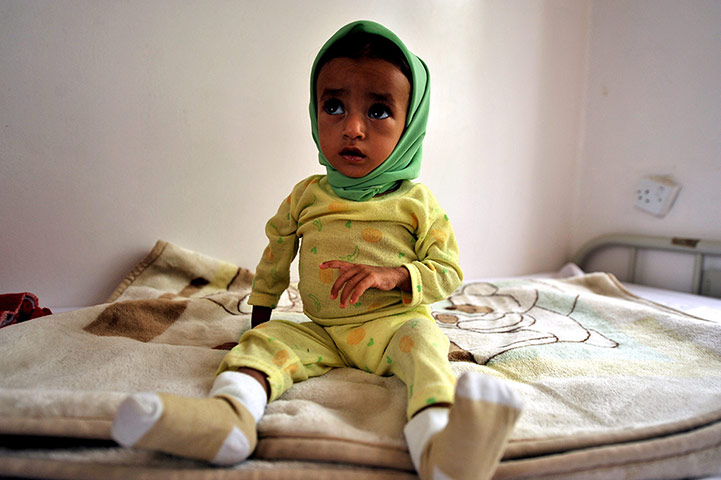 24 hours: Sana'a, Yemen: A dehydrated child sits on a bed waiting for treatment