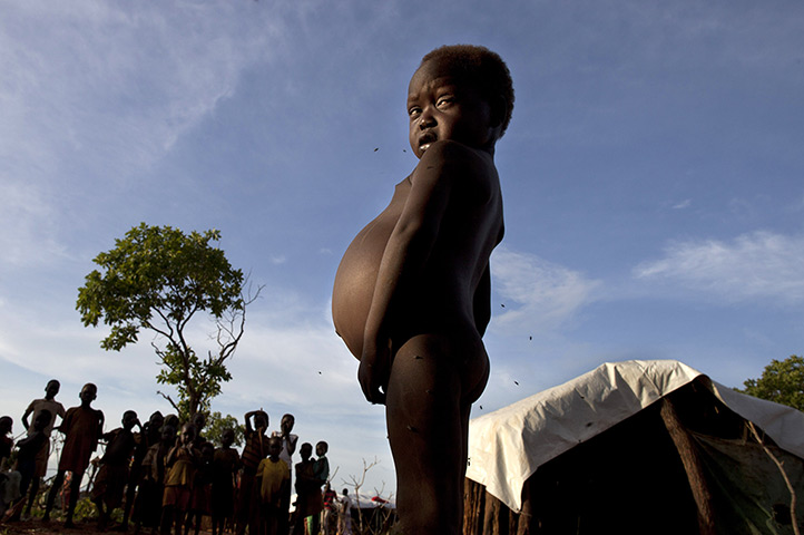 24 hours: South Sudan: A three year old boy suffering from malnutrition stands