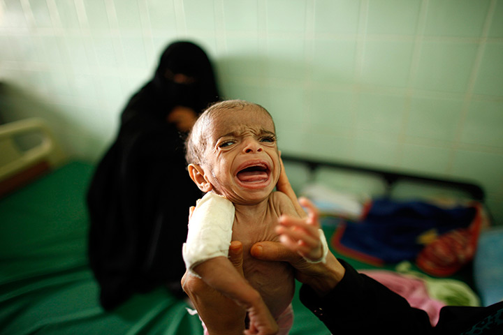 24 hours in pictures: A doctor holds a malnourished boy as mother sits at a therapeutic centre