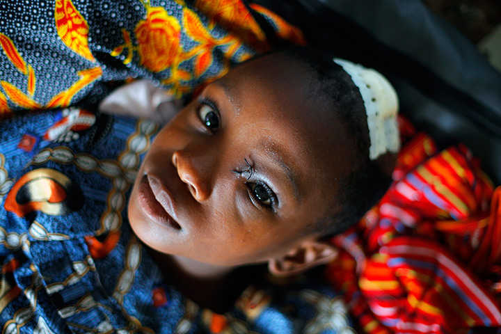 24 hours: Rutshuru, Congo: Mireille Iduhaye, 8, lies in her hospital bed