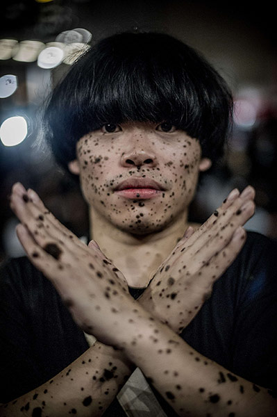 24 hours: A student with black dots on his face ge