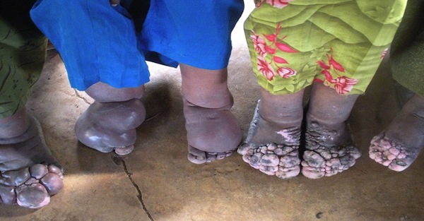 Elephantiasis in Ethiopia - in pictures