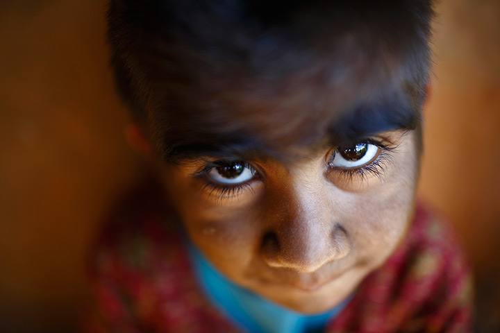 Werewolf syndrome: Mandira Budhathoki, 7, poses for a photograph