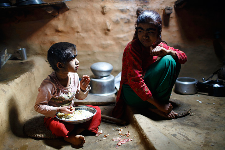 Werewolf syndrome: Manjura sits next to her younger sister Mandira as she eats lunch in the ki