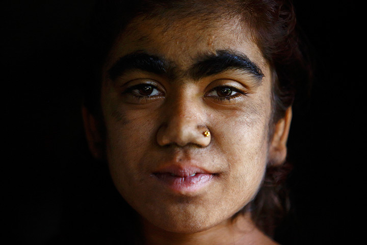 Werewolf syndrome: Manjura poses for a photograph before undergoing laser hair removal treatme