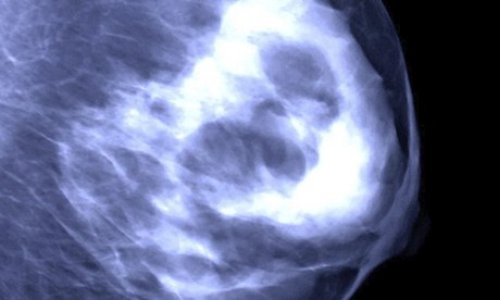 Breast mammogram