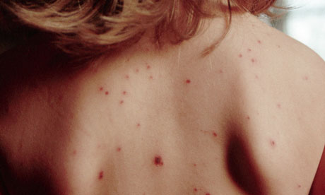 Five babies at suburban Chicago daycare center have measles