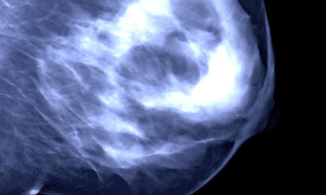 A mammogram shows a woman's breast