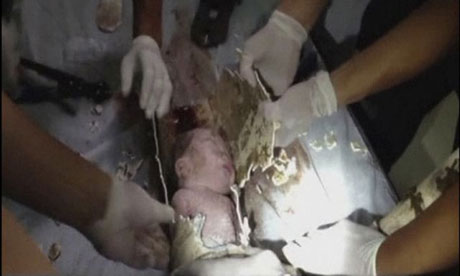 Doctors in China cut a newborn baby boy free from a sewage pipe