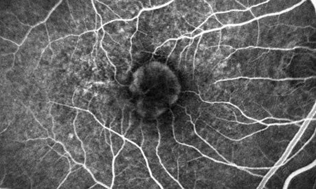 nhs could save 84m using cheaper drug to prevent blindness trial eye drug could save nhs 84m 460x276 nhs could save 84m using cheaper drug to prevent blindness trial eye drug could save nhs 84m 460x276
