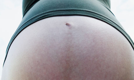 Obesity during pregnancy