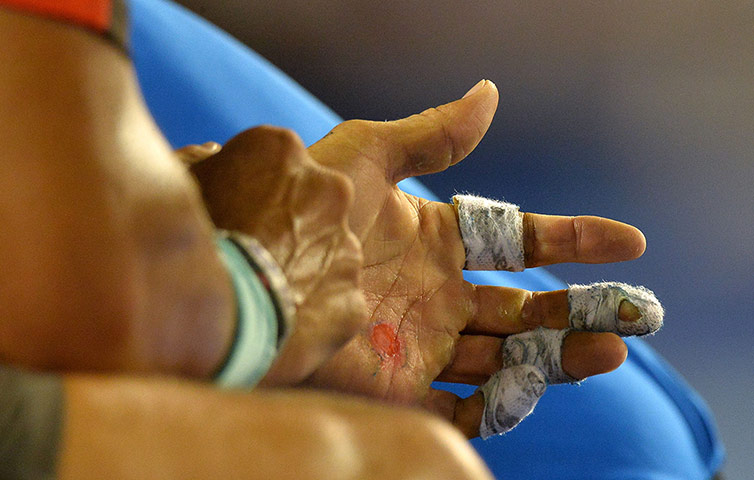 20 Photos: The blisters on Rafael Nadal's left hand at the 2014 Australian Open