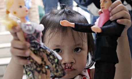A child with a cleft lip before surgery in Manila