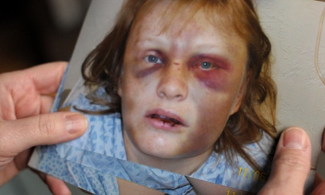 US Money private violence Deanna bruises