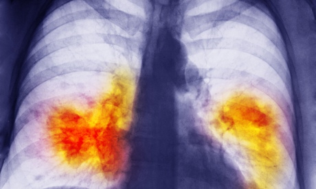 An x-ray showing lung cancer.